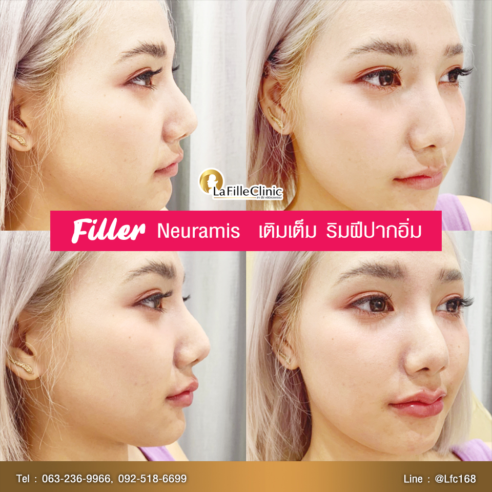 LFC-Filler-42