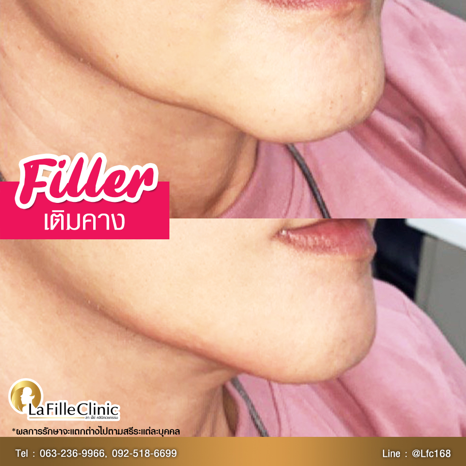 LFC-Filler-56w