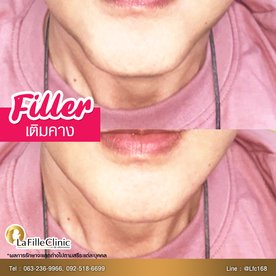 LFC-Filler-57w