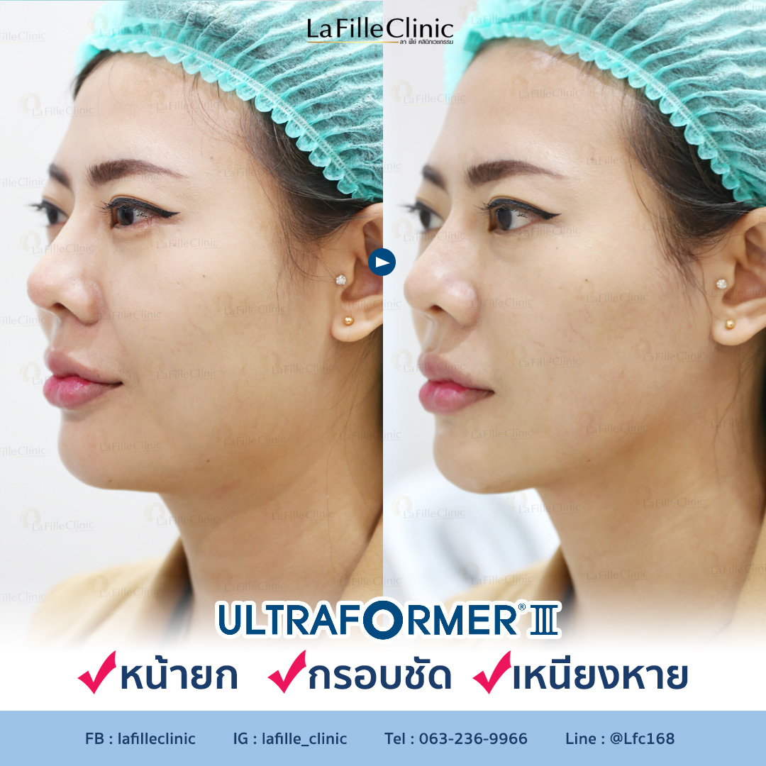 รีวิว Ultraformer - คลินิกความงาม